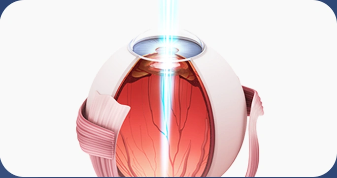 망막 레이저 치료